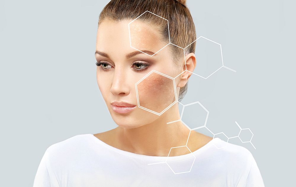 What Is Hyperpigmentation?