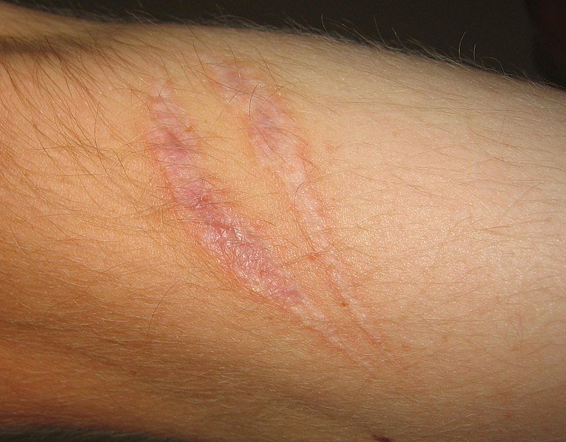 Derma Roller Effective in Treating Scars