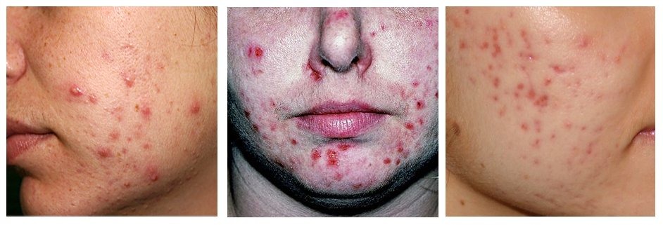 acne-photos