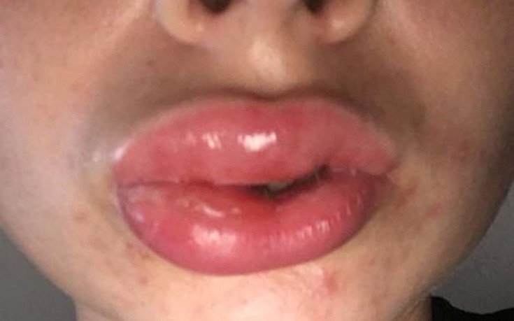 lipstick-allergy