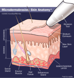 microdermabrasion-how-it-works