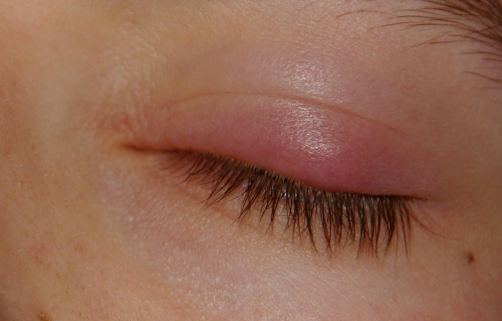 senstivie-eye-irritation-1024x655