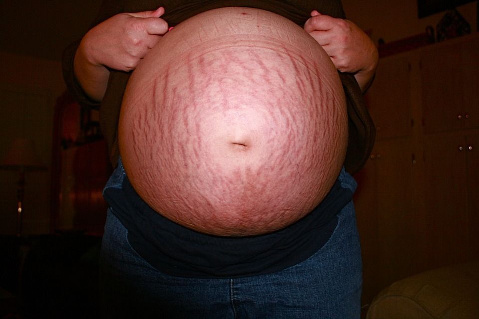 A pregnant belly full of stretch marks