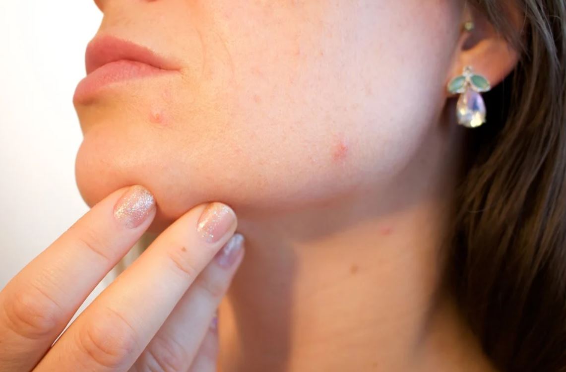 Do You Have Acne Scars that Refuse to Fade