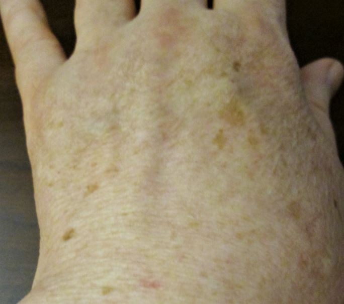 age spots on the left hand of a 63-year-old light-skinned man